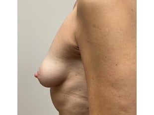 Breast Augmentation 110