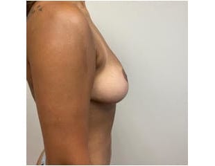 Breast Reduction NJ