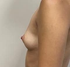 Breast augmentation New Jersey