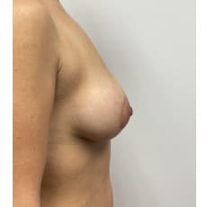 Breast Lift w Implants