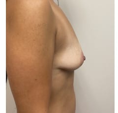 Breast Lift w Implants