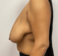 Breast Reduction with lift