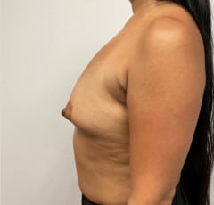 Breast Augmentation